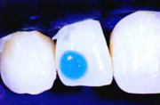 bijuterii-dentare3